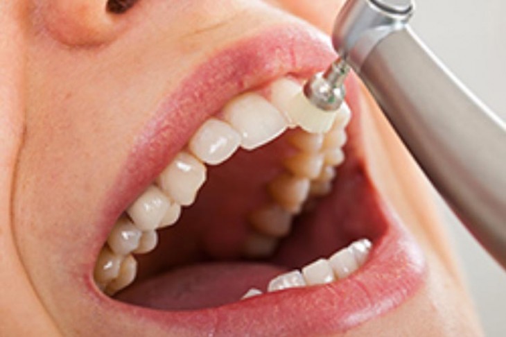 Diş Taşı Temizliği - Diş Hekimi Nilüfer