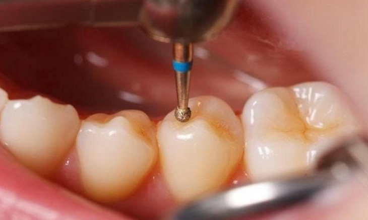 Bursa DM Diş Kliniği - Dolgu Nedir?