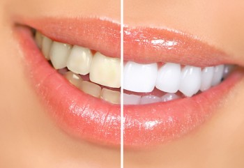 Diş Rengi Değişir Mi?