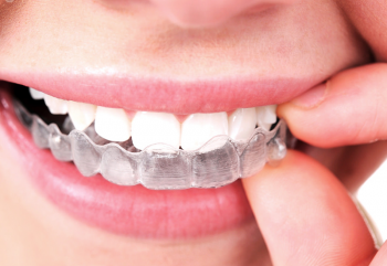 Telsiz Ortodonti Nedir?