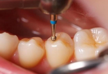 Bursa DM Diş Kliniği - Dolgu Nedir?