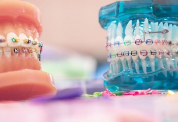 Bursa Diş Teli Fiyatları 2024 - Ortodonti Uzmanı Canan Çolak