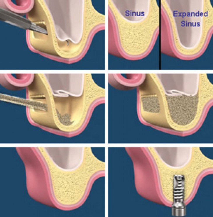 Sinüs Lifting Nedir Nilüfer Diş Kliniği İmplant