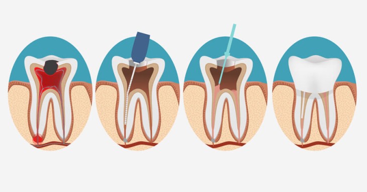 Kanal Tedavisi Nedir? DM Ağız ve Diş Sağılığı Polikliniği