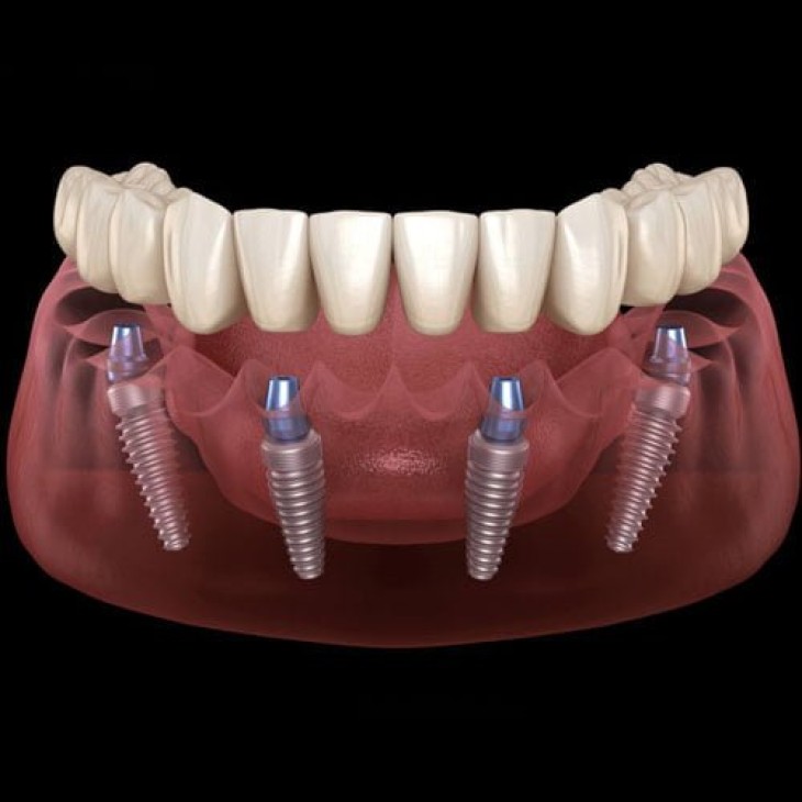 Dental Implants