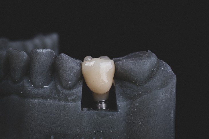 Immediate Implant
