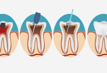 Bursa DM Diş Klinik - Kanal Tedavisi Nedir?