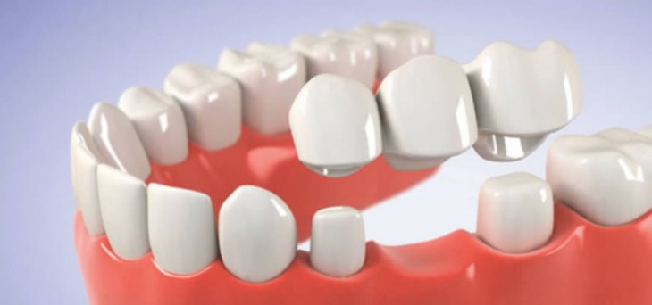 Bursa Diş Kliniği I Diş Protezleri