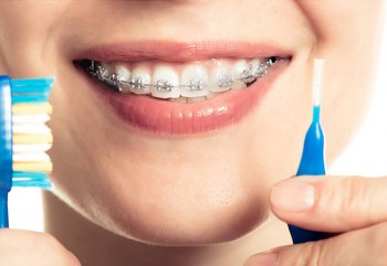 Diş teli bakımı nasıl yapılmalıdır?
