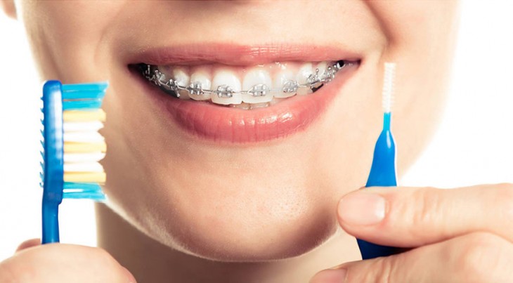 Diş teli bakımı nasıl yapılmalıdır?