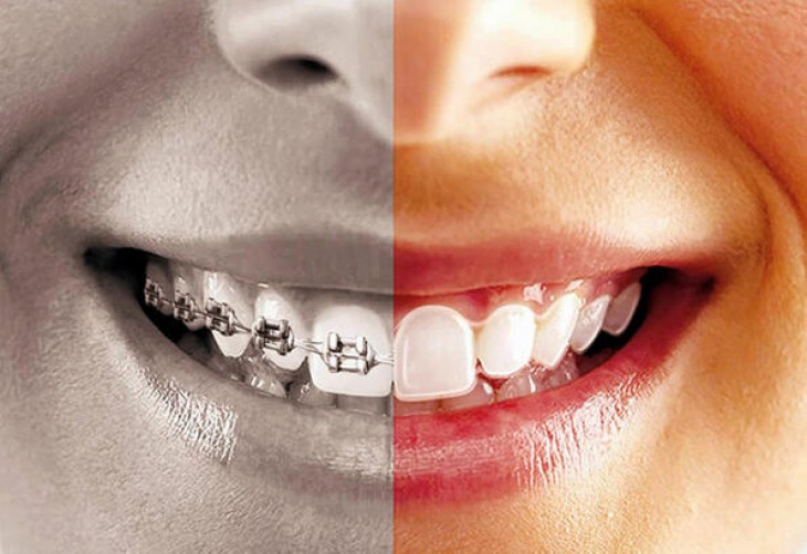 ما هو علاج تقويم الأسنان؟