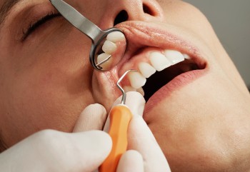 Diş Taşı Temizliği Nasıl Yapılır?