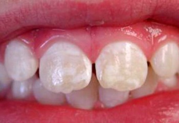 Dişlerde Görülen Beyaz Lekeler
