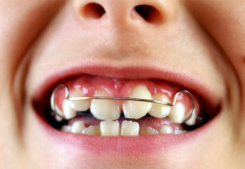 Diş Teli Tedavisi Zorlukları