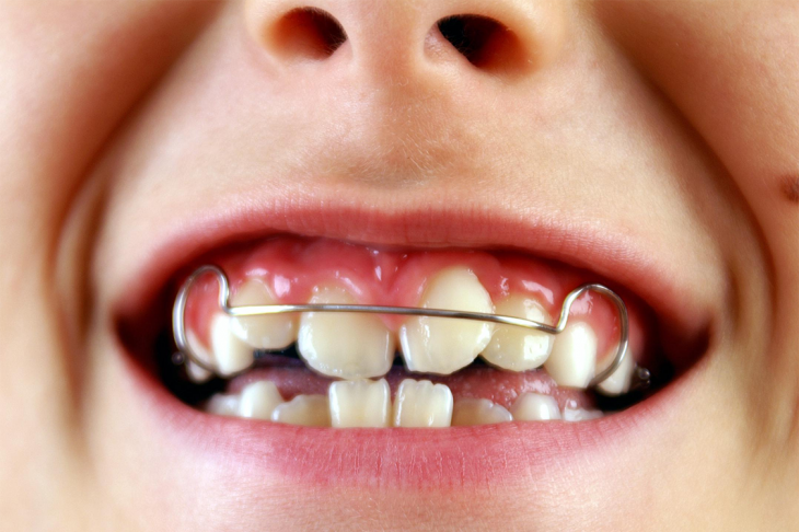 Diş Teli Tedavisi Zorlukları
