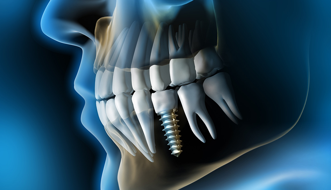 Bursa implant- DM agiz ve dis saglıgı