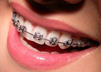 Bursa ortodonti Tedavisi - DM ağız ve diş sağlığı