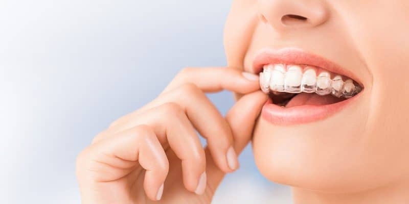 şeffaf plaklar ile diş tedavisi