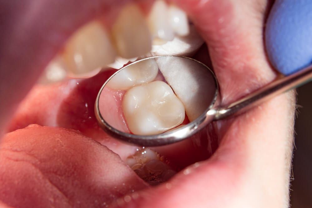 diş sızlaması tedavisi bursa